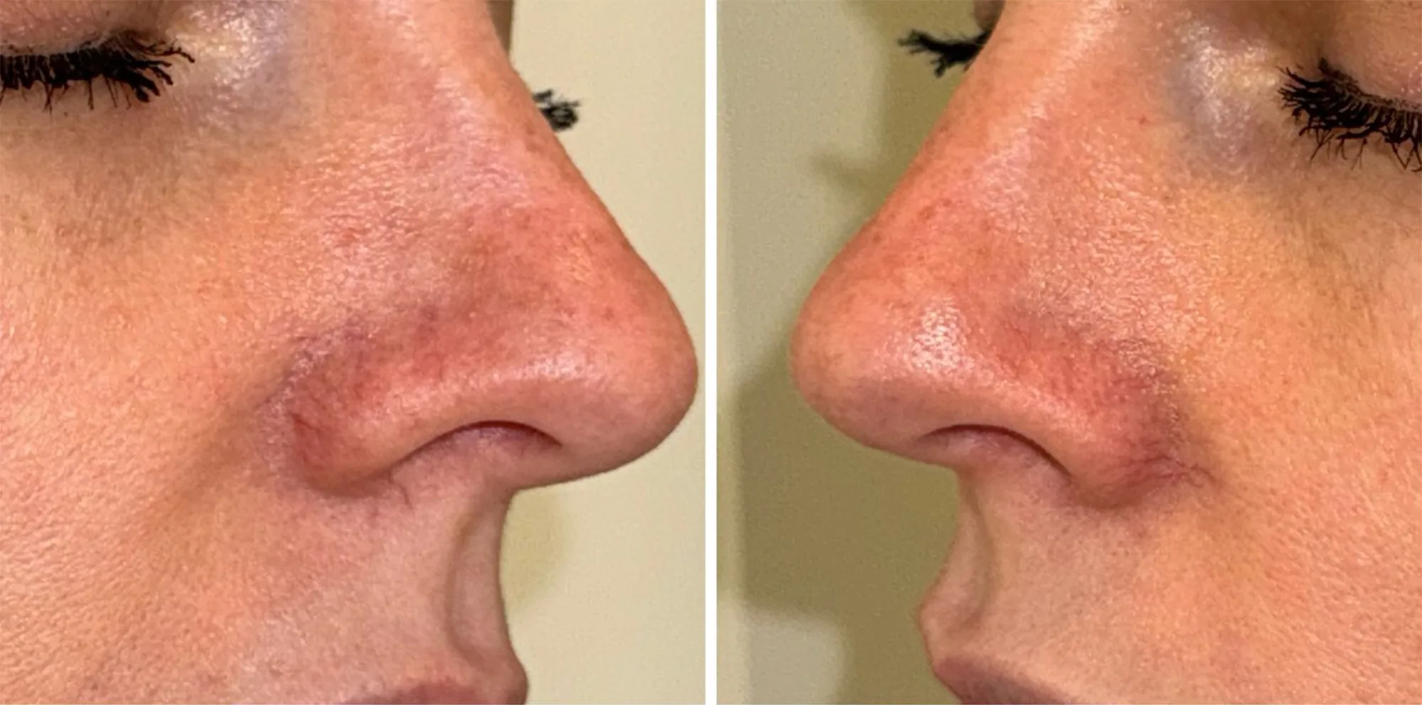 Side view of a face with visible redness, hyperpigmentation and uneven tone before a Lumecca IPL treatment at the Miren Medic clinic.