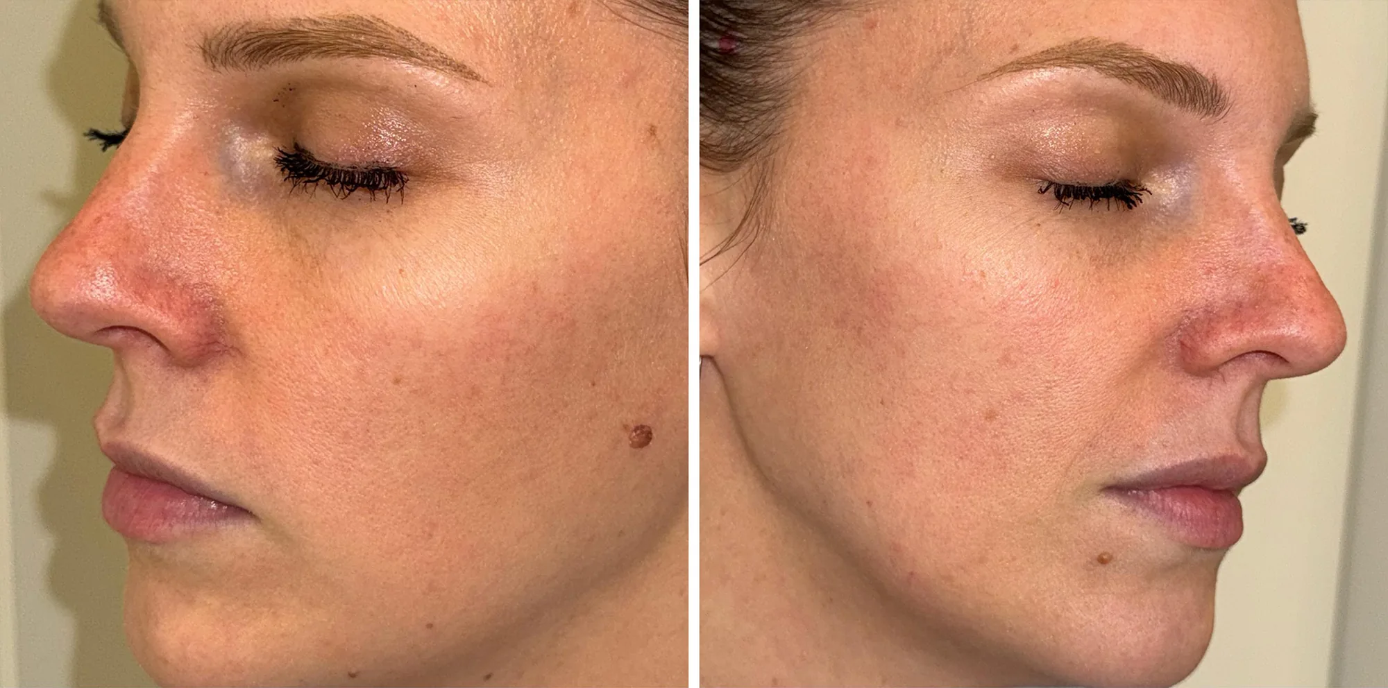 Side view of a face with visible redness, hyperpigmentation and uneven tone before a Lumecca IPL treatment at the Miren Medic clinic.