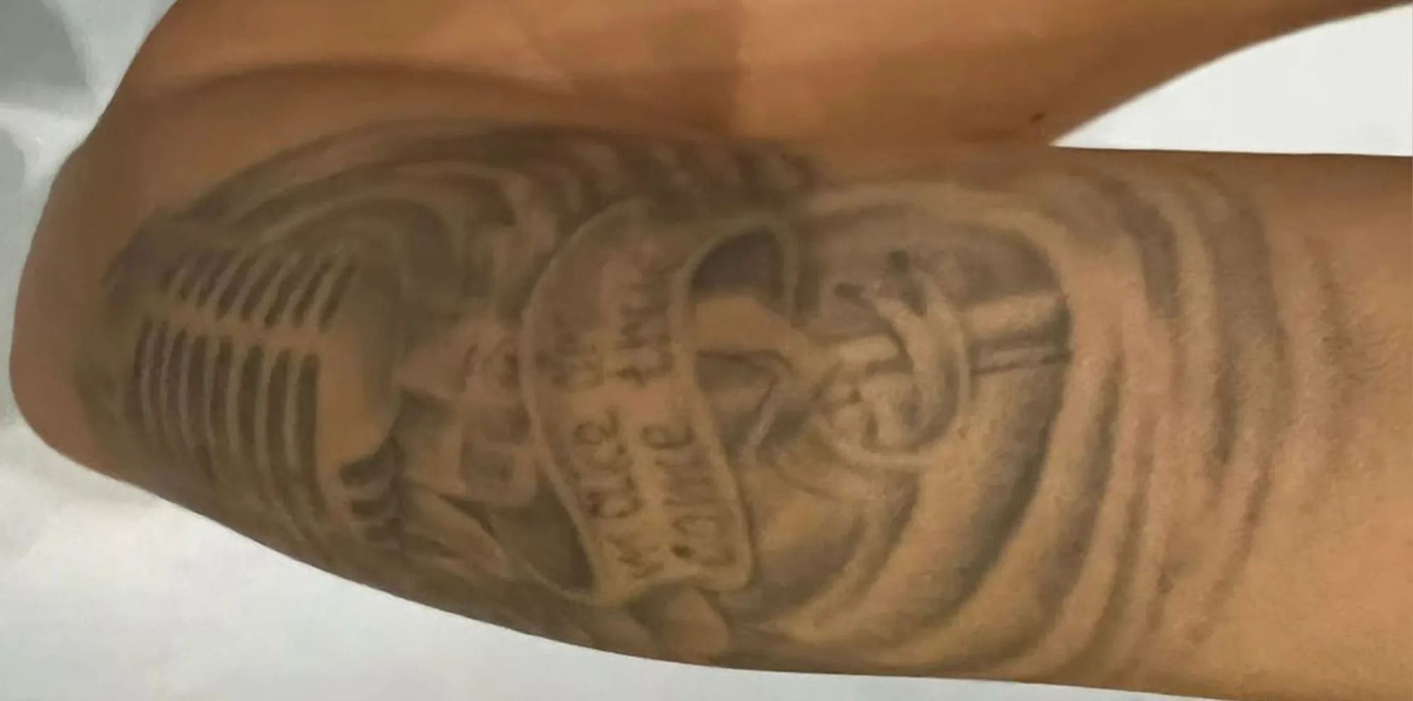 Black tattoo on the skin before laser removal with the PicoWay device at the Miren Medic clinic.