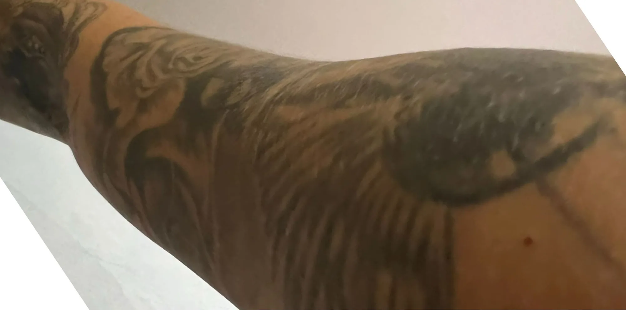 Black tattoo on the skin before laser removal with the PicoWay device at the Miren Medic clinic.