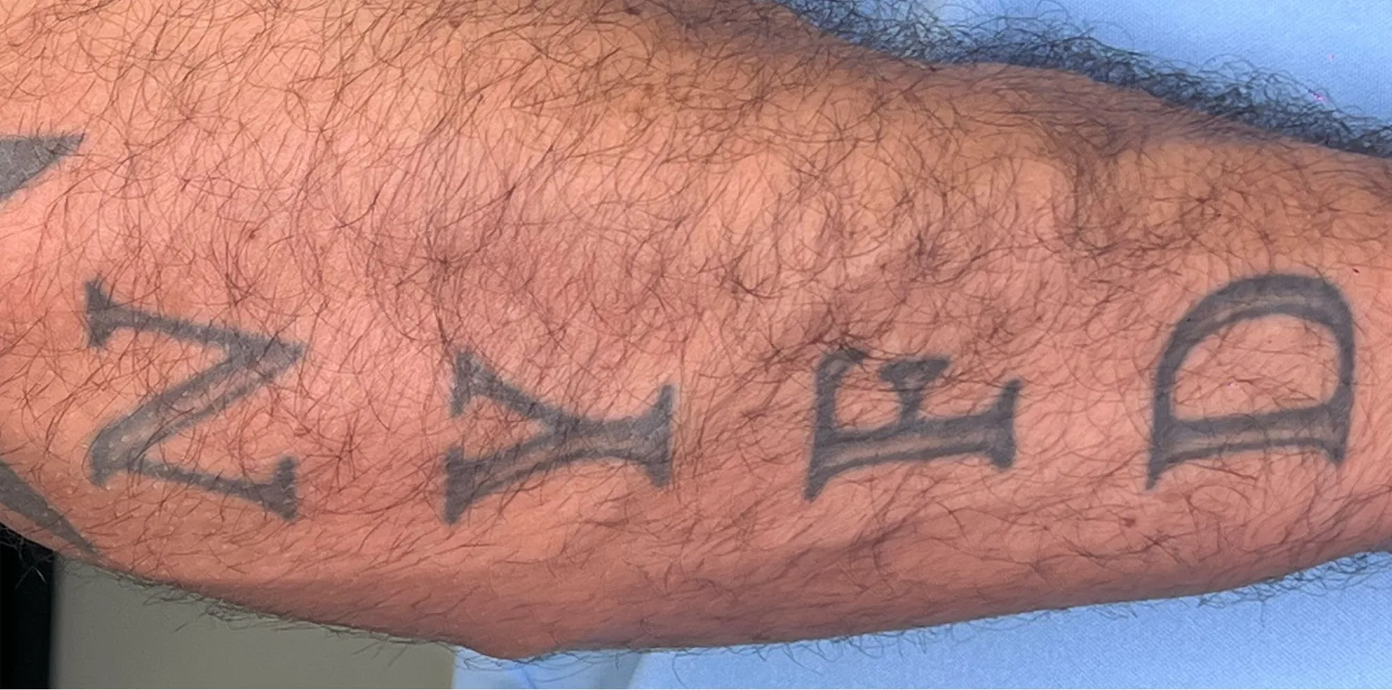 Black tattoo on the skin before laser removal with the PicoWay device at the Miren Medic clinic.