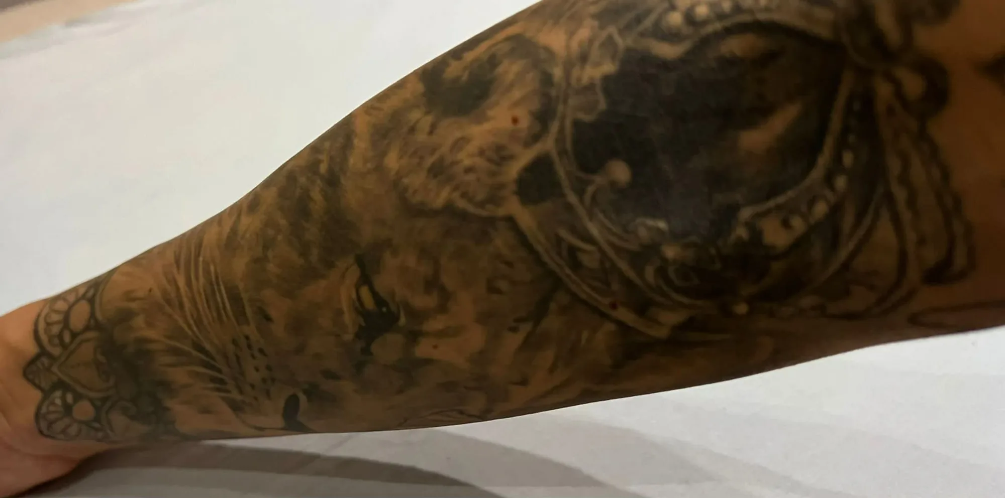 Black tattoo on the skin before laser removal with the PicoWay device at the Miren Medic clinic.