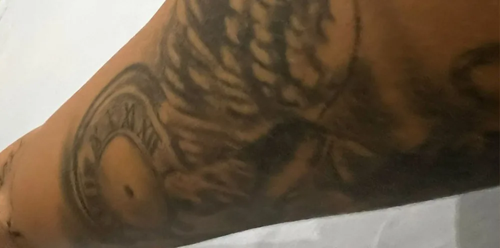 Black tattoo on the skin before laser removal with the PicoWay device at the Miren Medic clinic.
