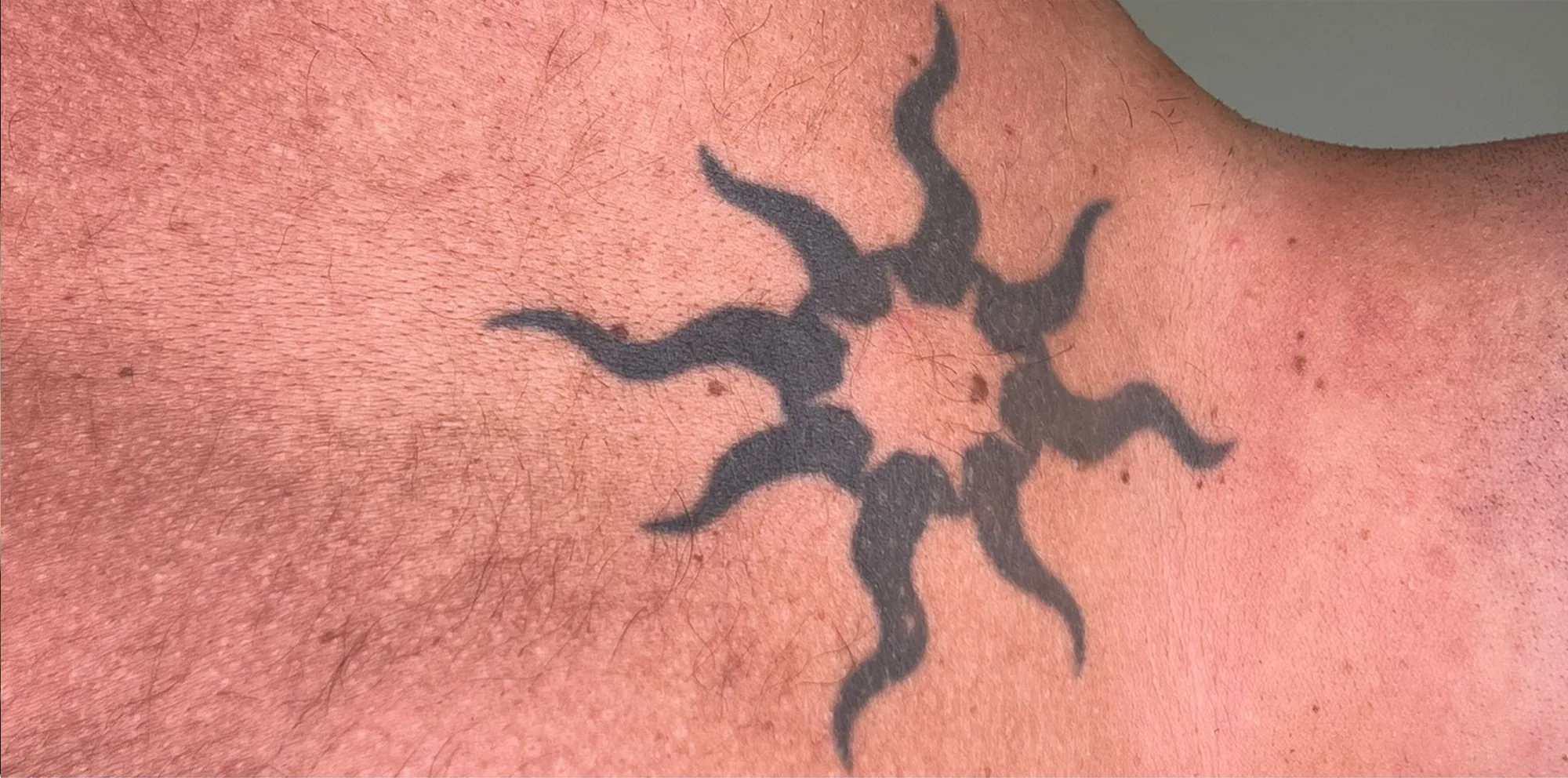 Black sun shaped tattoo on the skin before laser removal with the PicoWay device at the Miren Medic clinic.