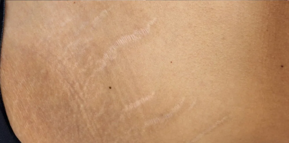 Close up of skin with pronounced white stretch marks and uneven texture before a Morpheus8 treatment at the Miren Medic clinic.