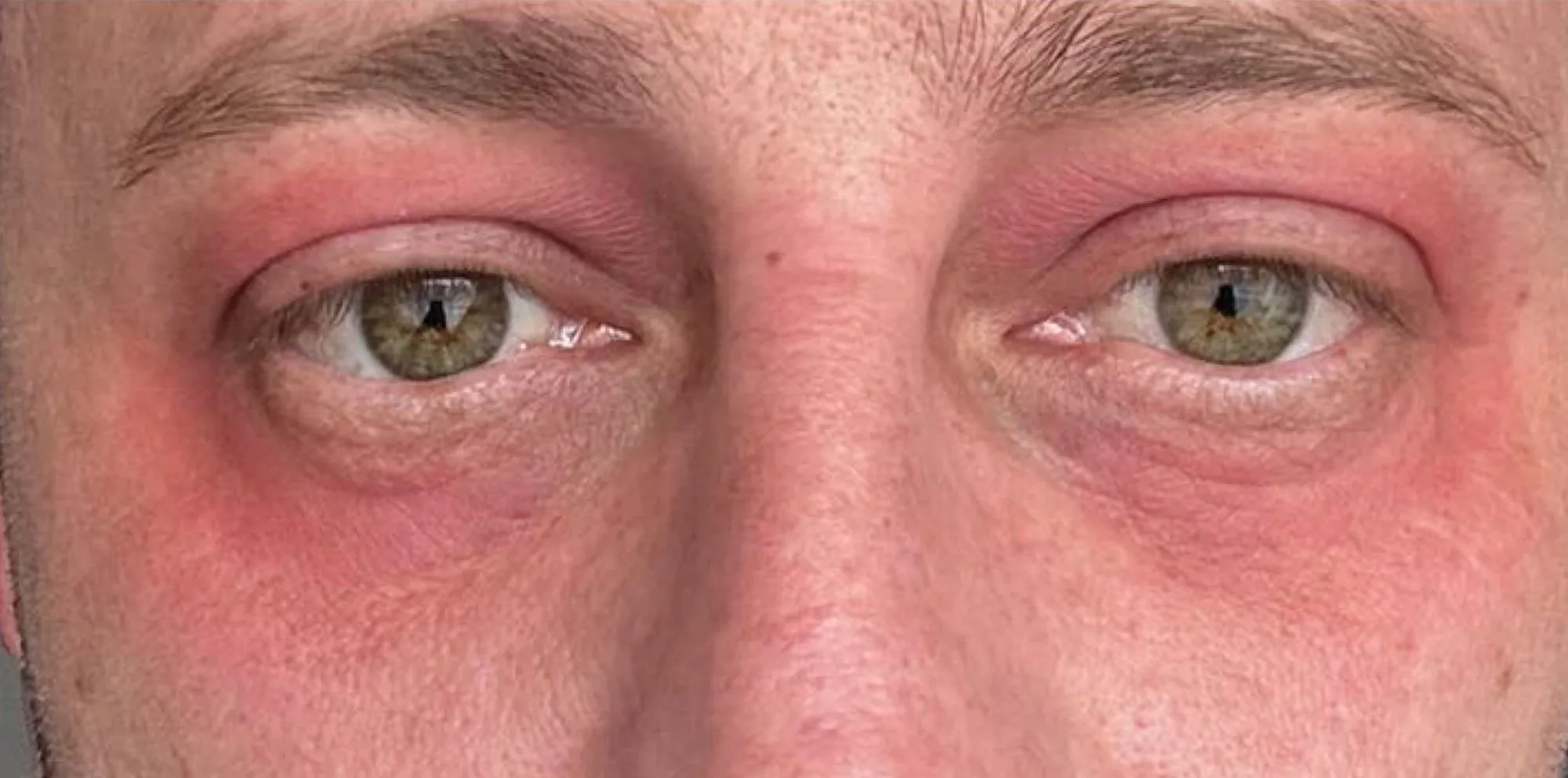 Close up of the eye area with tighter skin, reduced dark circles and softened lines after fractional CO2 laser treatment at the Miren Medic clinic.