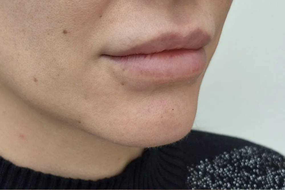 Close up of lips before aesthetic correction with hyaluronic acid fillers at the Miren Medic clinic.