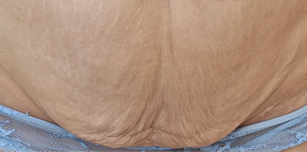 Markedly lax and wrinkled abdominal skin with visible stretch marks before a Morpheus8 treatment at the Miren Medic clinic.