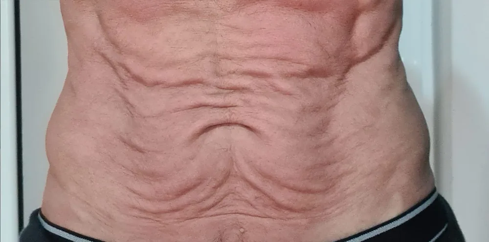 Markedly lax and wrinkled abdominal skin with deep folds before a Morpheus8 treatment at the Miren Medic clinic.