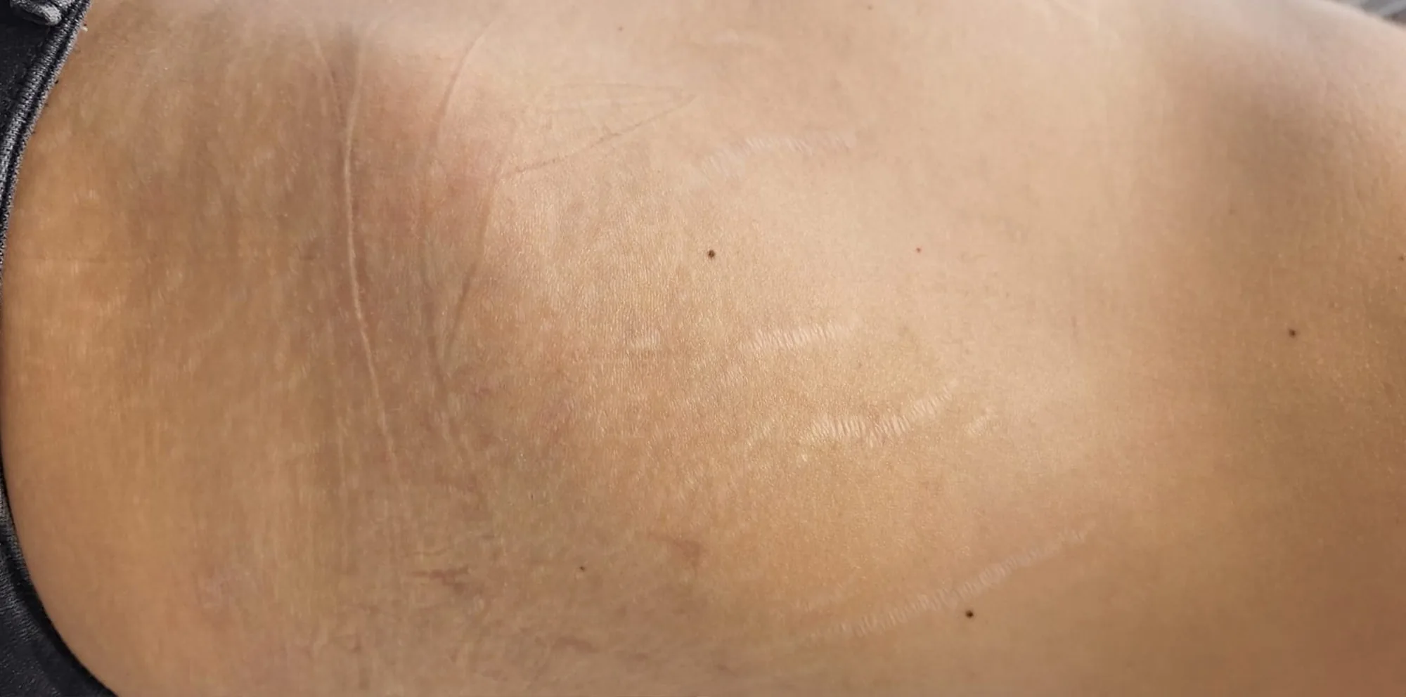 Skin with softened stretch marks and improved texture after a Morpheus8 treatment at the Miren Medic clinic.