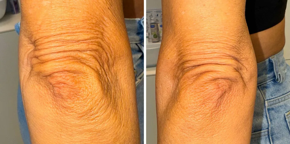 Lax, wrinkled elbow skin before a Morpheus8 treatment at the Miren Medic clinic.