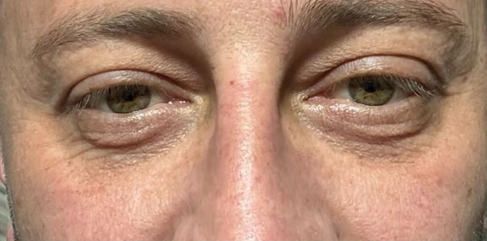 Eye area with pronounced dark circles, under eye bags and lax eyelid skin before fractional CO2 laser treatment at the Miren Medic clinic.
