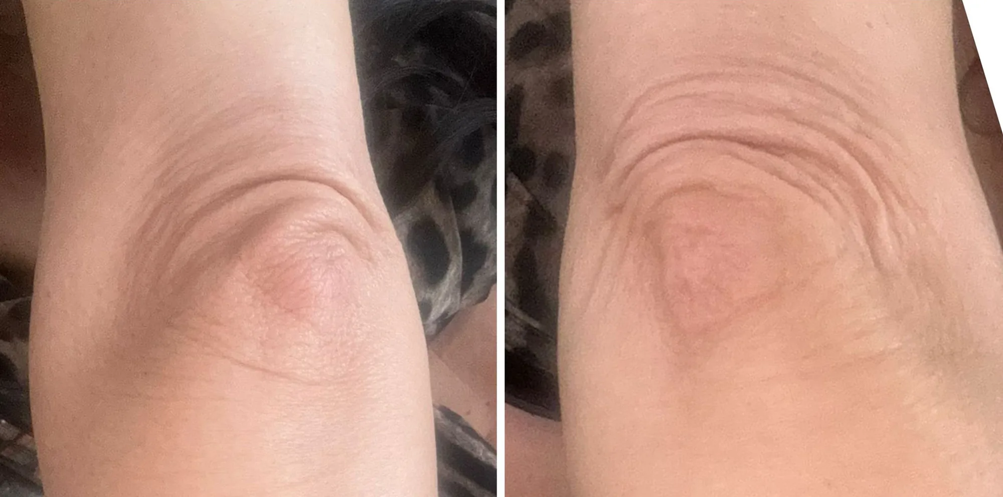 Tightened elbow skin after a Morpheus8 treatment at the Miren Medic clinic, with visibly improved tone and texture.