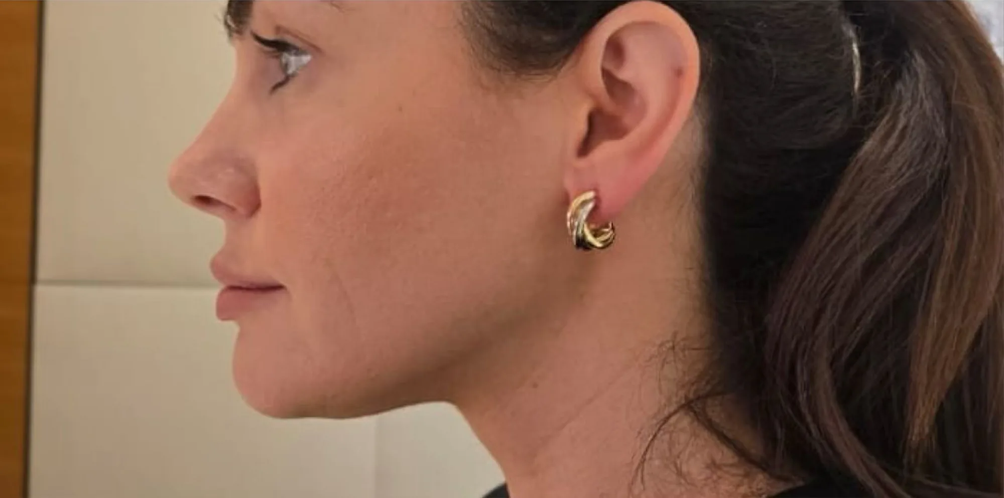 Result after an Endolift laser treatment at the Miren Medic clinic: a clearly defined jawline and tighter neck skin.