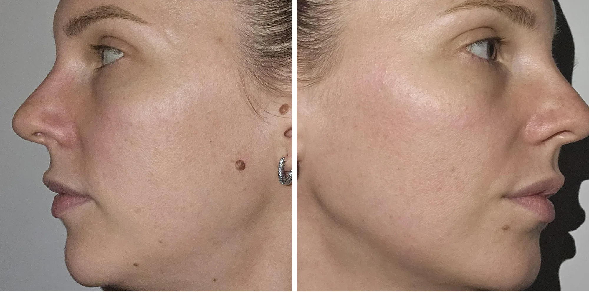 Result after a Lumecca IPL treatment at the Miren Medic clinic: clear facial skin with no redness or hyperpigmentation and an even tone.