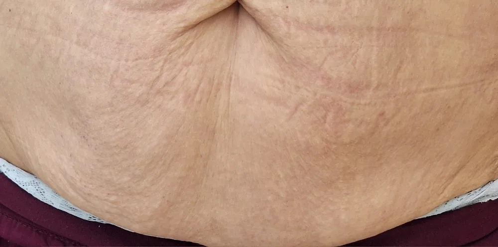 Result after a Morpheus8 abdominal treatment at the Miren Medic clinic: significantly tighter skin with reduced folds and improved texture.