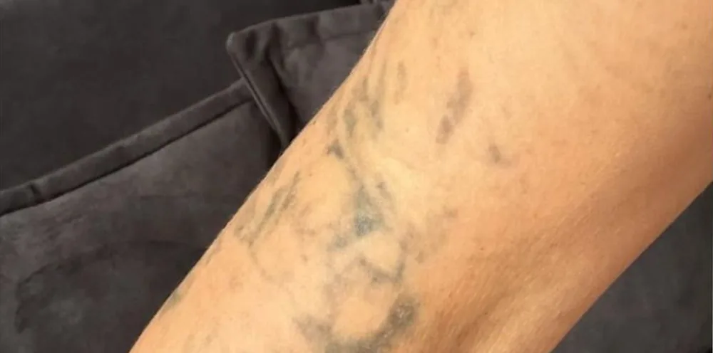 Result after a PicoWay laser treatment at the Miren Medic clinic: skin with the black tattoo pigment almost completely cleared.