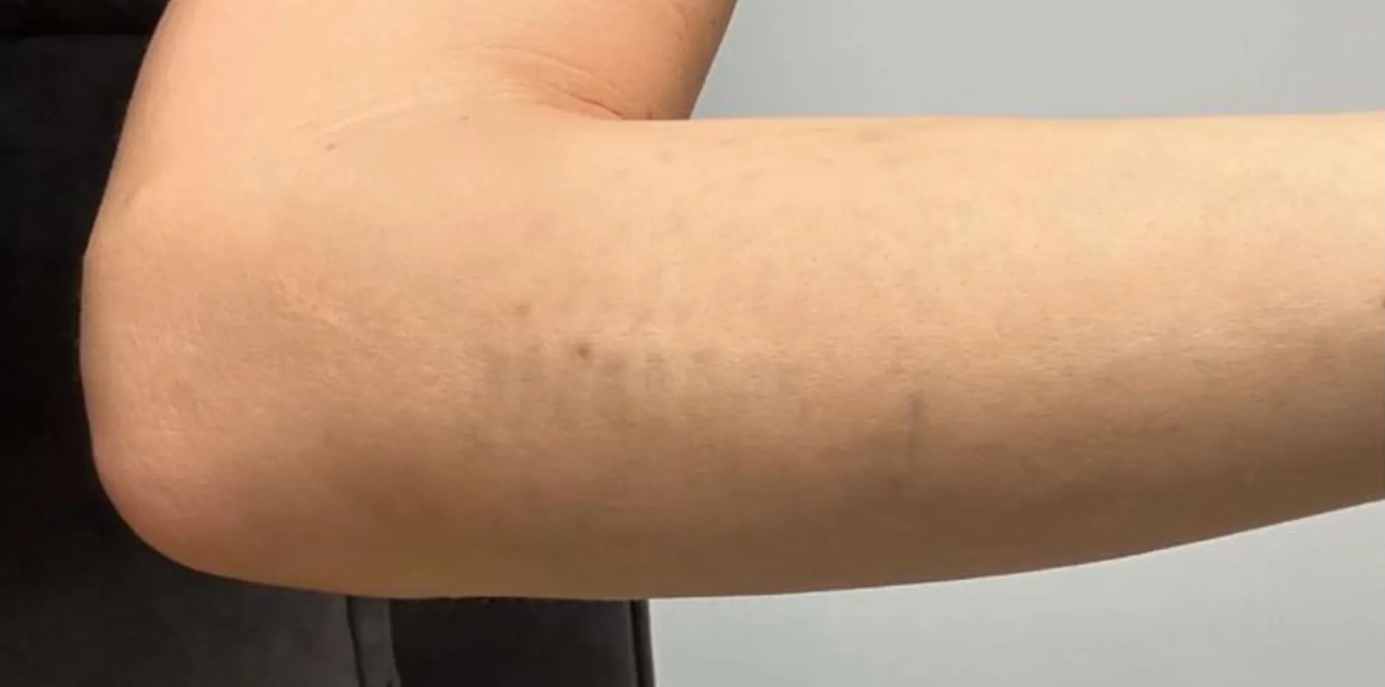 Result after a PicoWay laser treatment at the Miren Medic clinic: skin with the black tattoo pigment almost completely cleared.
