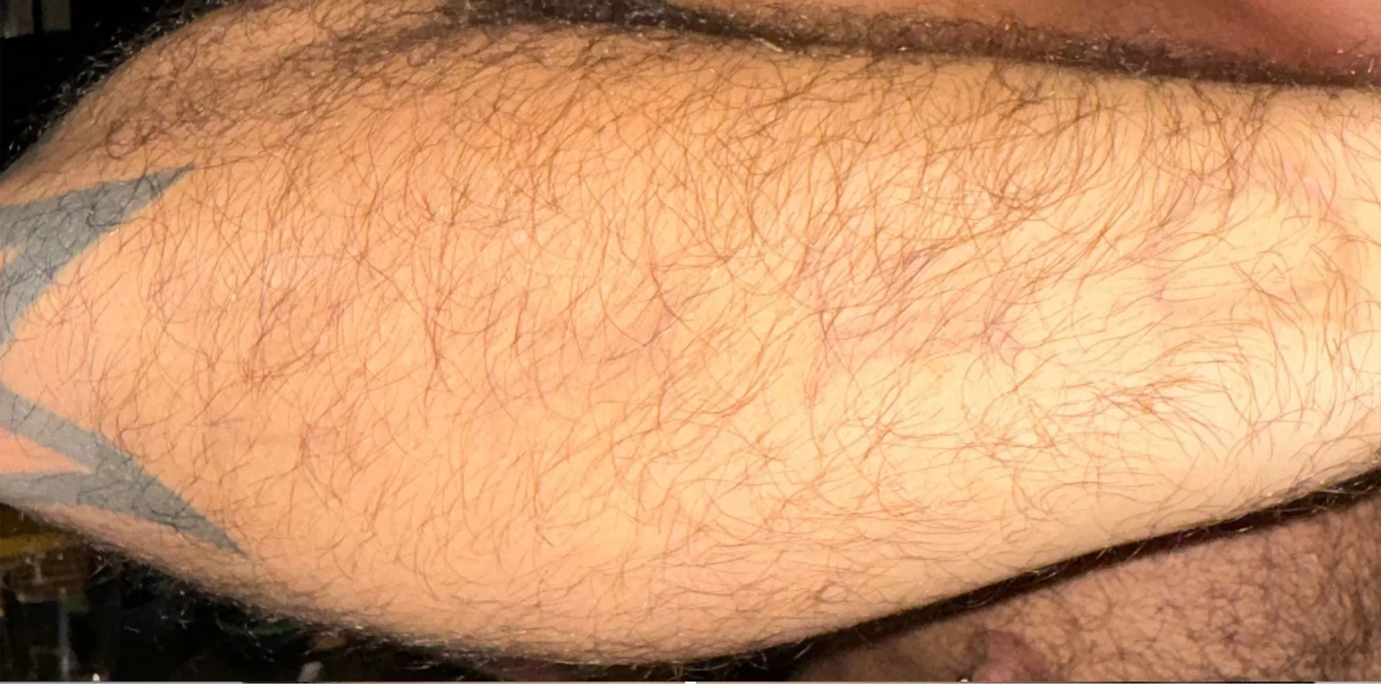 Result after a PicoWay laser treatment at the Miren Medic clinic: skin with the black tattoo pigment almost completely cleared.