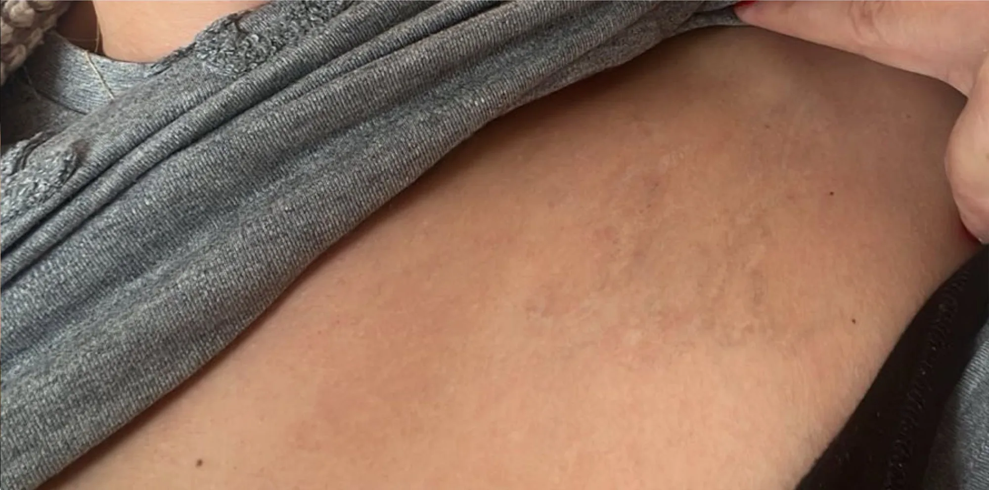 Result after a PicoWay laser treatment at the Miren Medic clinic: skin with the black tattoo pigment almost completely cleared.