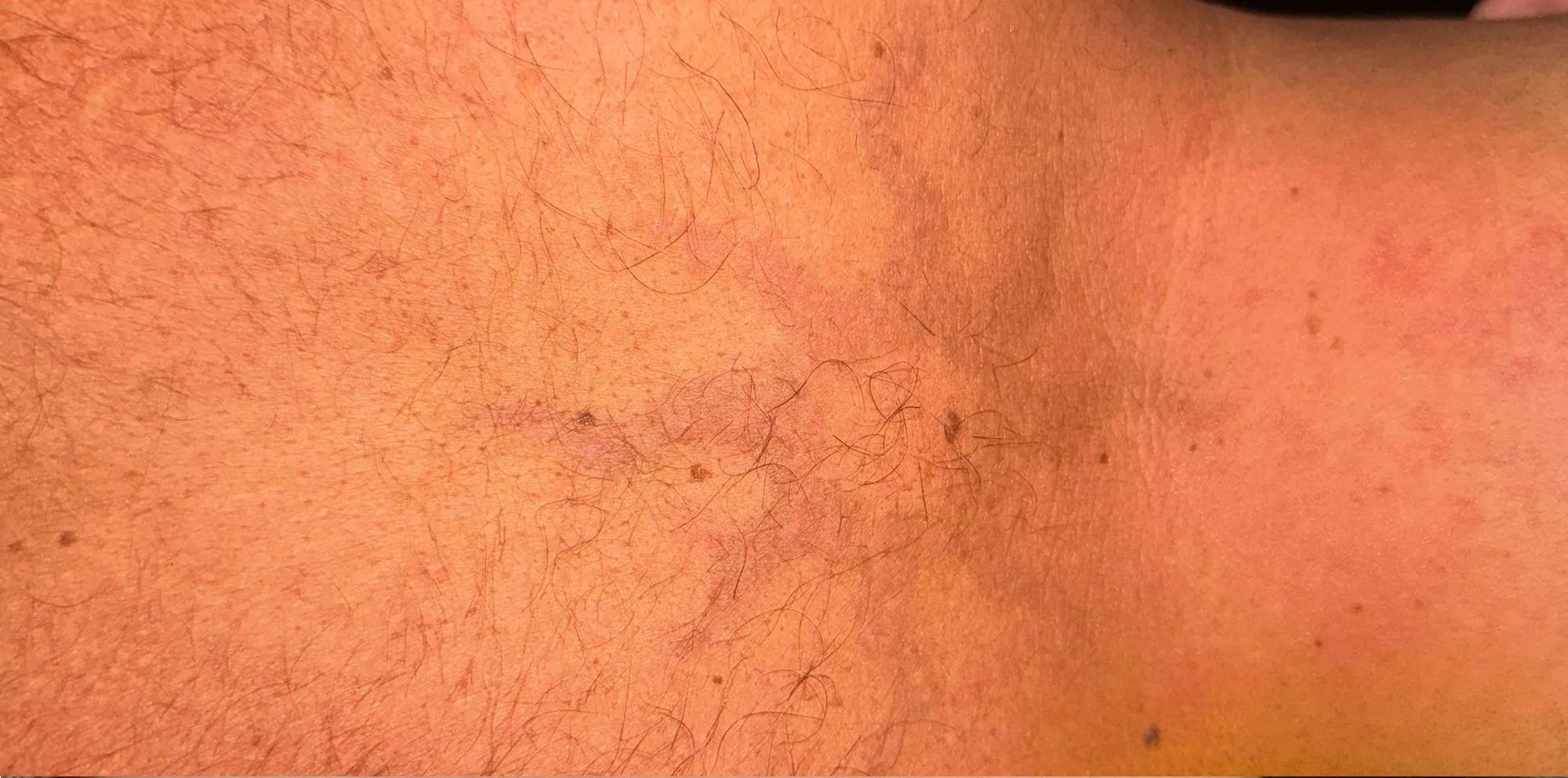 Result after a PicoWay laser treatment at the Miren Medic clinic: skin with the black tattoo pigment almost completely cleared.