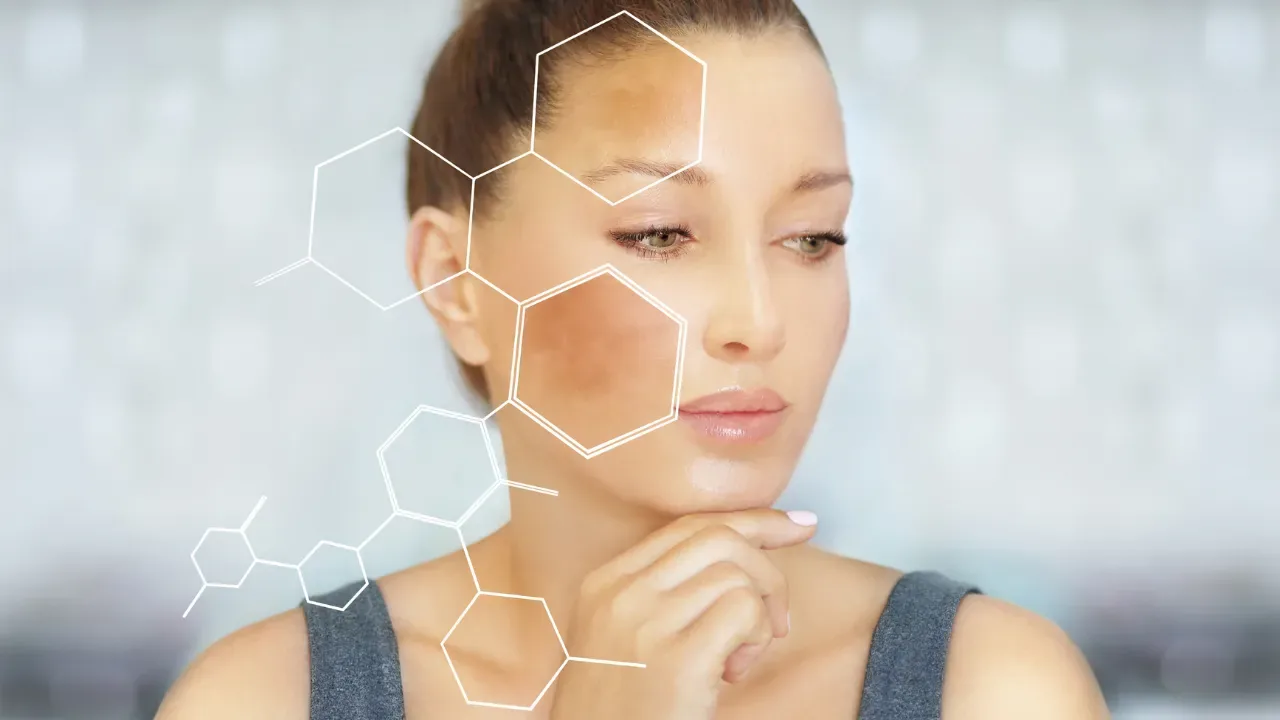 Stylized image of a woman's face with hyperpigmentation and graphic molecular networks symbolizing the skin treatment process at the Mirenmedic clinic.